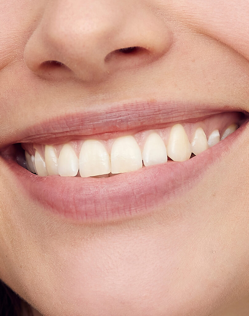 Crowns – Smile 360