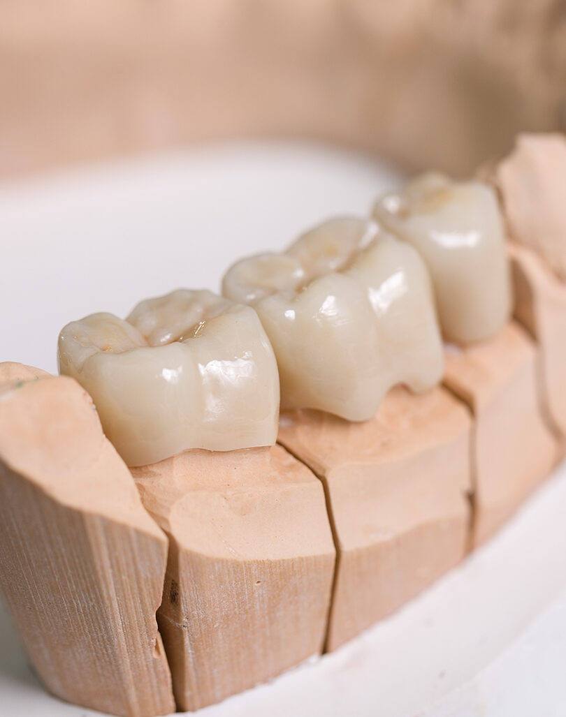 Bridges – Smile 360