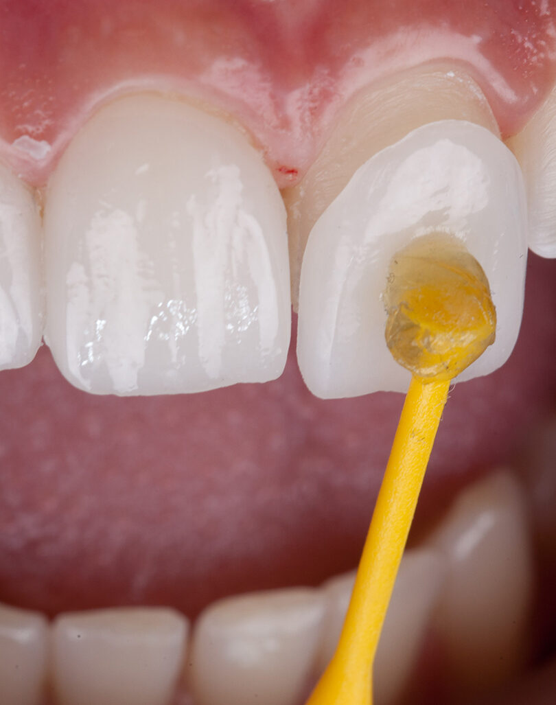 Veneers – Smile 360