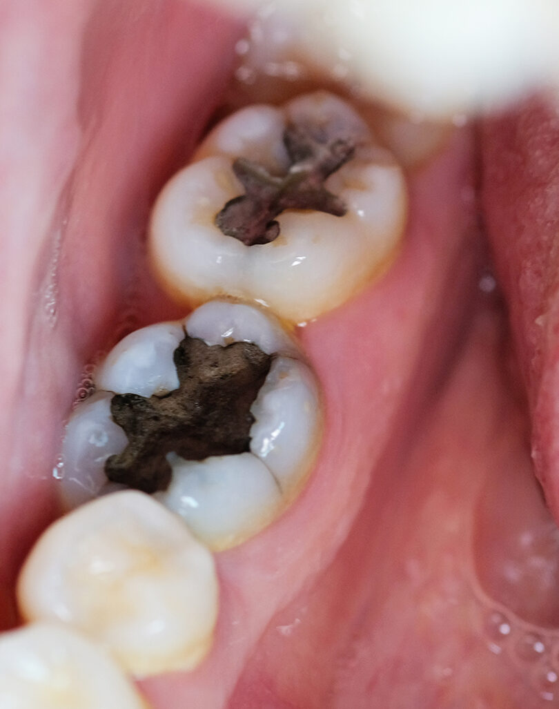 Fillings – Smile 360