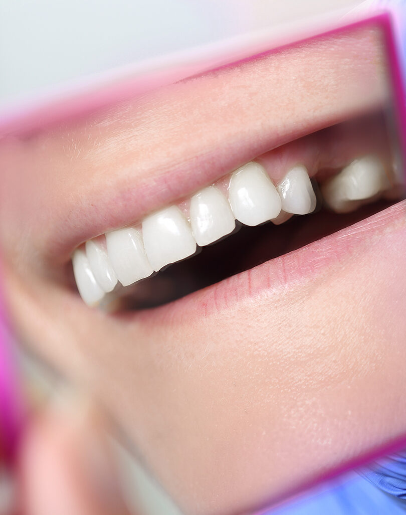 Implant Retained Bridge – Smile 360