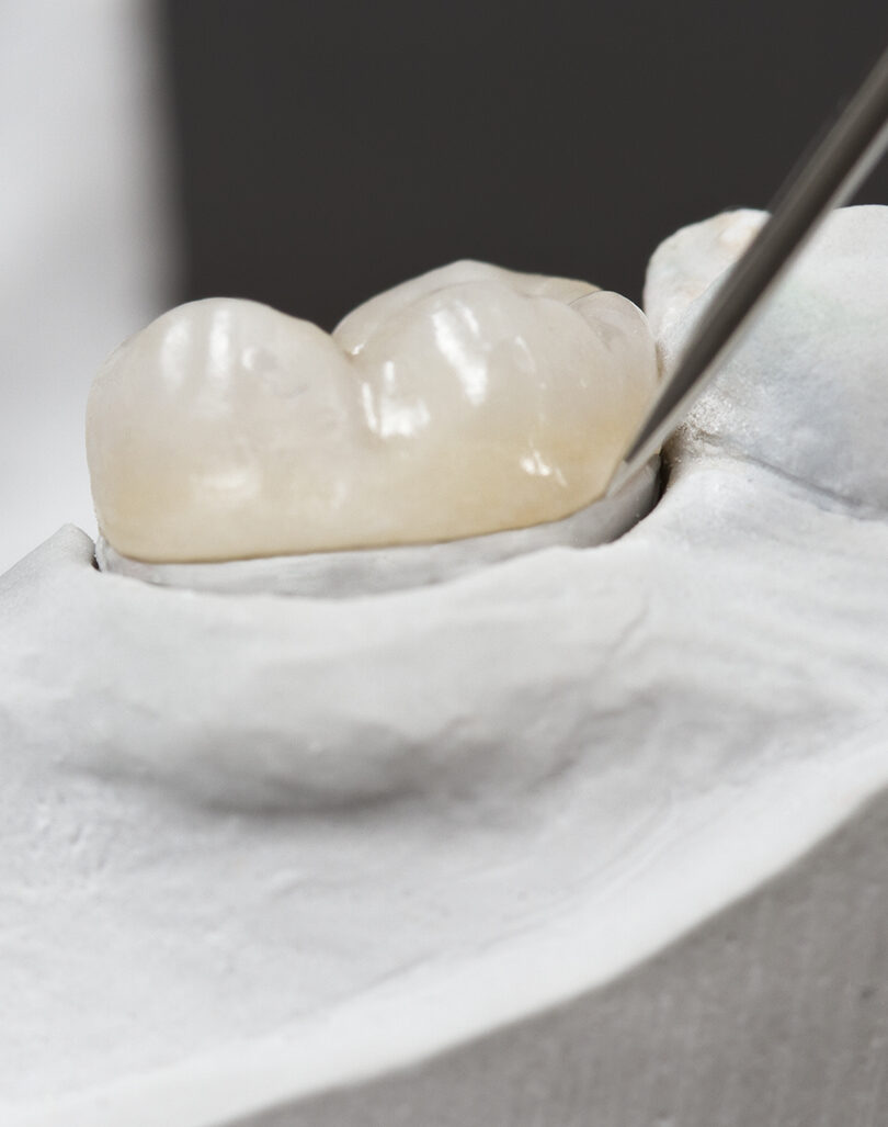 Inlays and onlays – Smile 360