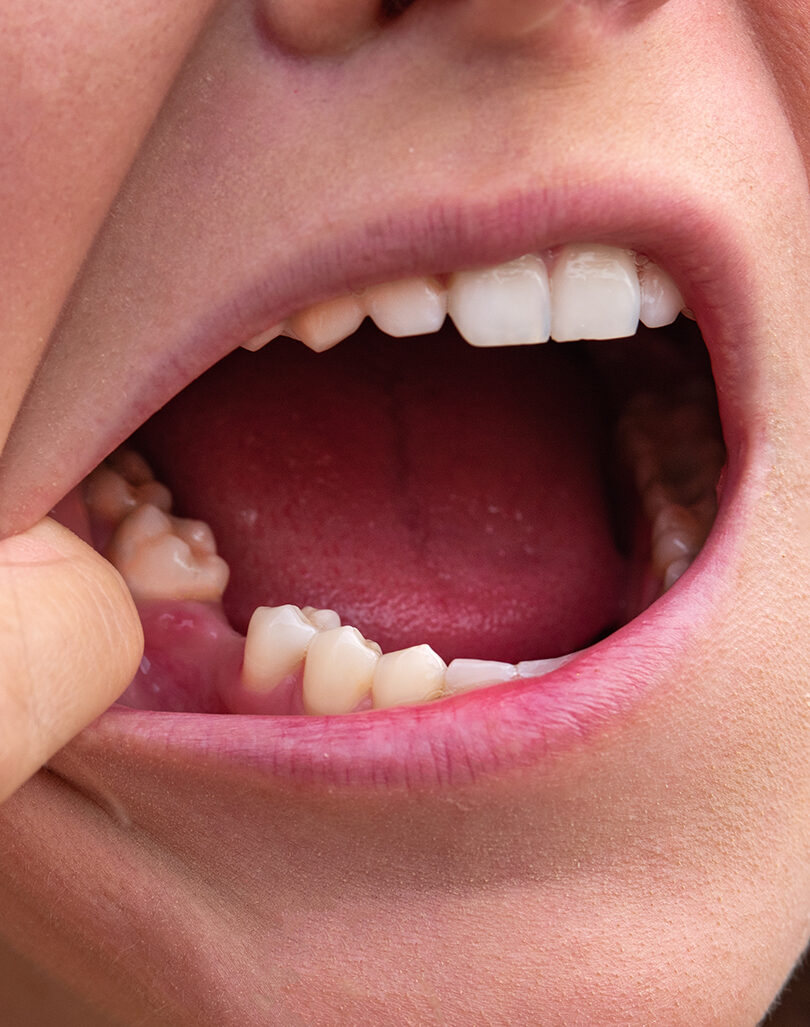 Missing Teeth – Smile 360