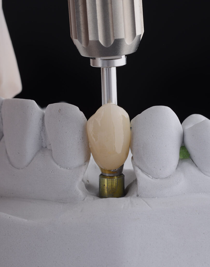 Single Tooth  Dental Implants – Smile 360