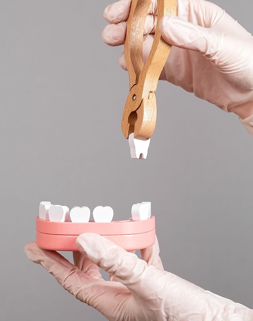 Tooth Extraction – Smile 360